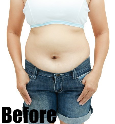Before-Abdominal Lift