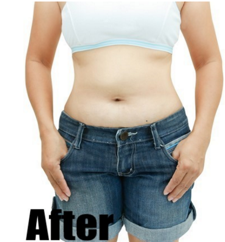After-Abdominal Lift