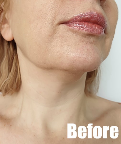 Before-Anti-Aging