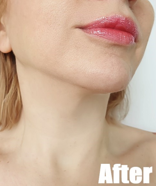 After-Anti-Aging