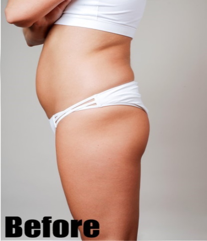 Before-Liposuction & Butt Lift