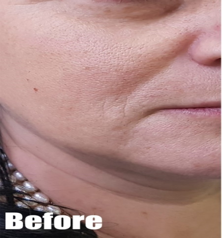 Before-Facelift