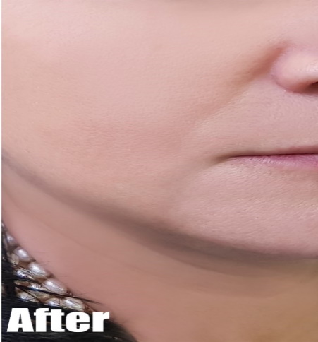 After-Facelift