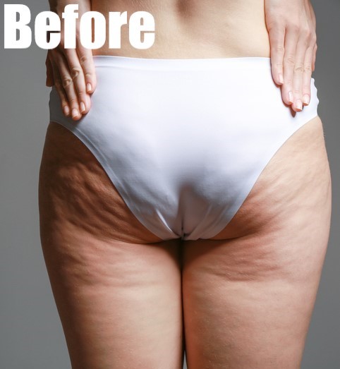 Before-Butt Lift