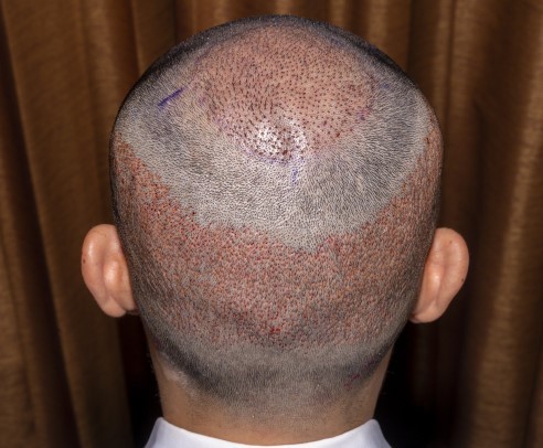 Before-Hair Transplant