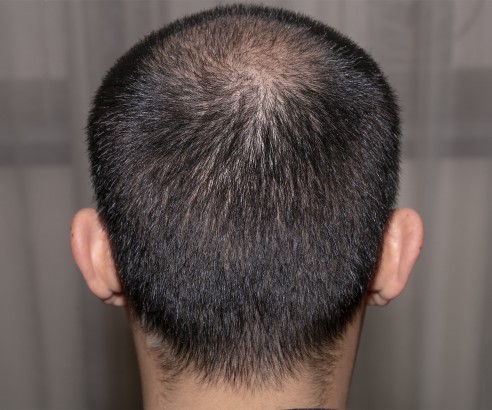 After-Hair Transplant