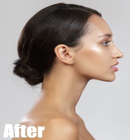 After-Jaw Lift