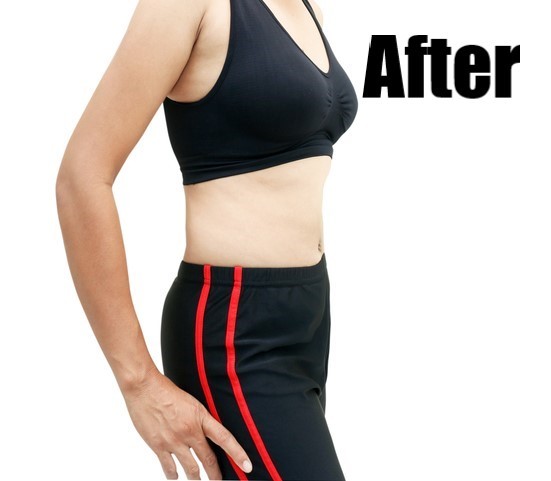 After-Arm Reduction