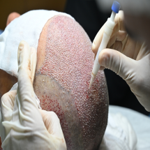 Hair Transplant in Delhi NCR